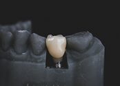 A tooth is embedded in a dental mould.